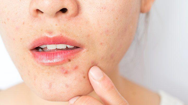 Causes of adult acne